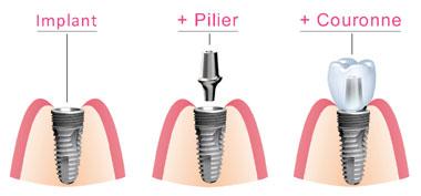 Composants implant dentaire à Marseille 13003
